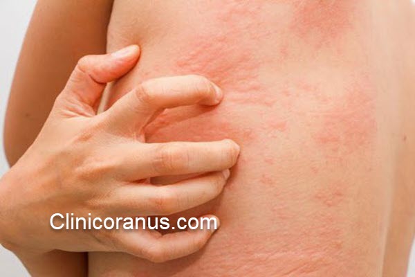 مشکلات پوستی ناشی از آب استخر | کلینیک اورانوس