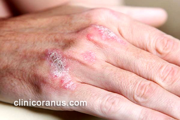 جراحی تومورهای پوستی | کلینیک اورانوس