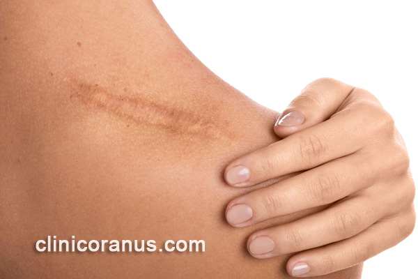 درمان زخم و اسکار | کلینیک اورانوس