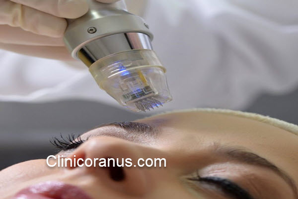 آر اف جوانسازی سه بعدی | کلینیک اورانوس