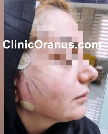 بلافاصله-بعد-از-لیفت-با-نخ-clinicoranus بهترین مرکز لیفت با نخ | کلینیک اورانوس