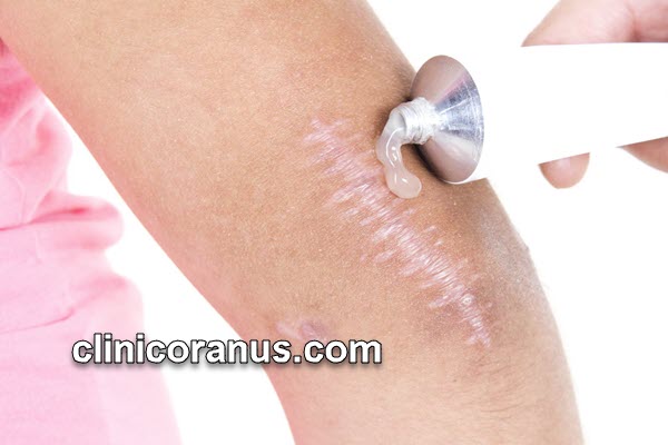 بهترین روش از بین بردن جای اسکار قدیمی | کلینیک اورانوس