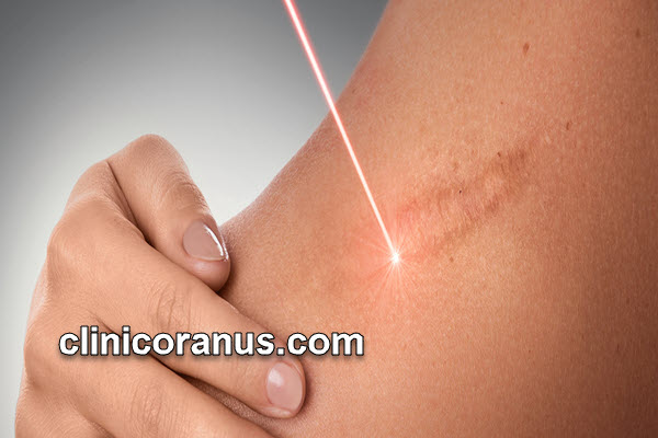 بهترین روش از بین بردن جای اسکار قدیمی | کلینیک اورانوس