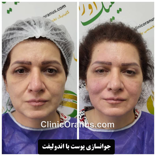 جوانسازی پوست با اندولیفت | کلینیک اورانوس
