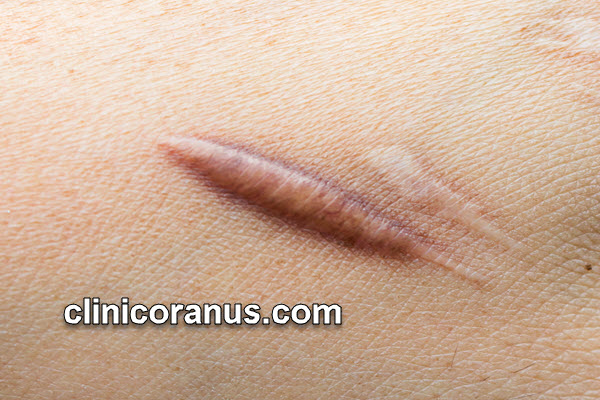 بهترین روش از بین بردن جای اسکار قدیمی | کلینیک اورانوس