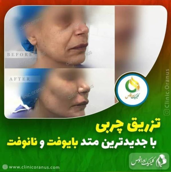 تزریق چربی با متد نانوفت و بایوفت | کلینیک اورانوس