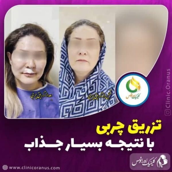 تزریق چربی در غرب تهران | کلینیک اورانوس