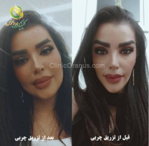 تزریق چربی | کلینیک اورانوس