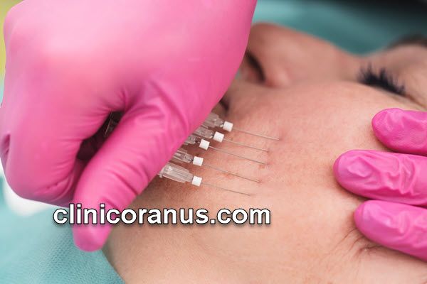 لیفت صورت با نخ در غرب تهران | کلینیک اورانوس