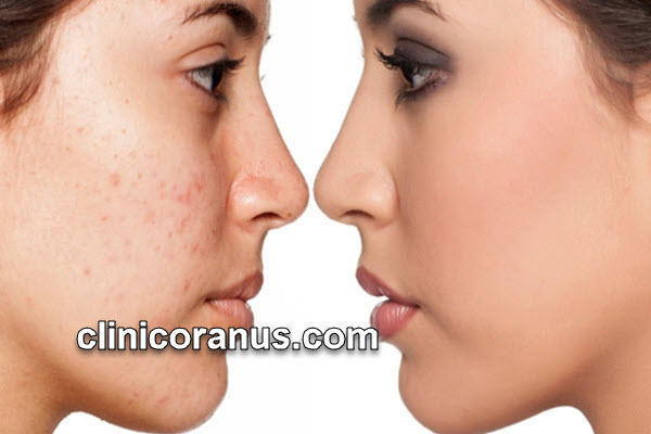بهترین کلینیک زیبایی برای رفع لک صورت | کلینیک اورانوس