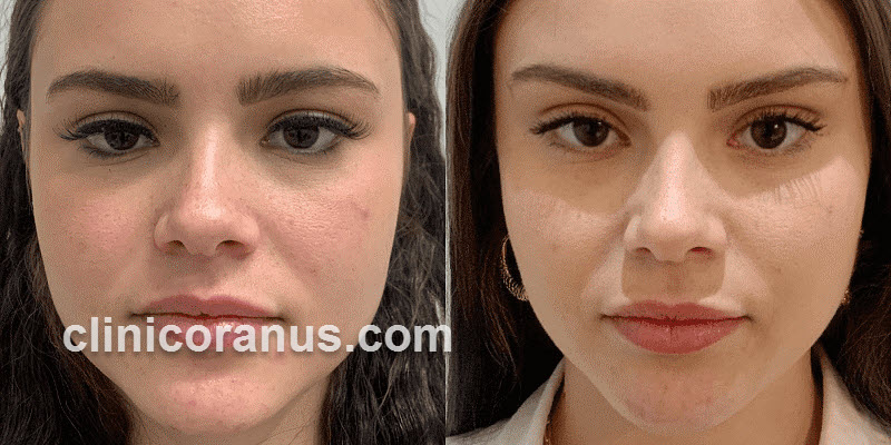 ویژگی های بهترین دکتر لیفت با نخ در تهران | کلینیک اورانوس