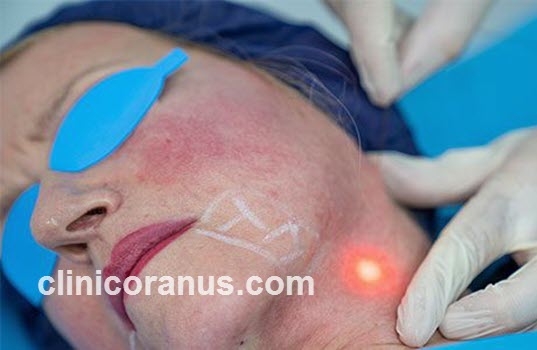 بهترین مرکز لیزر اندولیفت در جنت آباد | کلینیک اورانوس