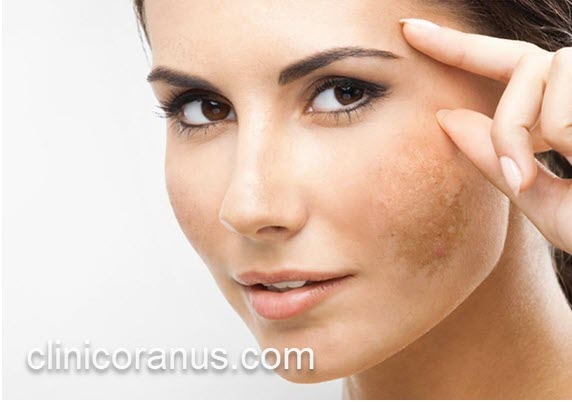 نحوه پیشگیری از ایجاد لک های صورت | کلینیک اورانوس 