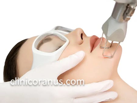 برداشتن خال با استفاده از لیزر co2 فرکشنال | کلینیک اورانوس