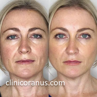 مزایای انجام لیفت با نخ در مرکز تخصصی لیفت صورت با نخ | کلینیک اورانوس