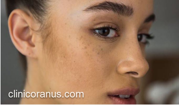 سریع ترین روش از بین بردن لک قهوه ای صورت | کلینیک اورانوس