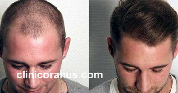 مراحل کاشت مو به روش میکروگرافت | کلینیک اورانوس