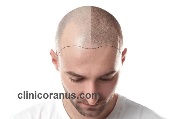 بررسی مزایای جدیدترین روش کاشت مو | کلینیک اورانوس