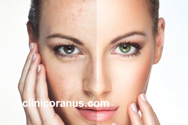 بهترین کلینیک جوانسازی پوست بدون جراحی در غرب تهران | کلینیک اورانوس