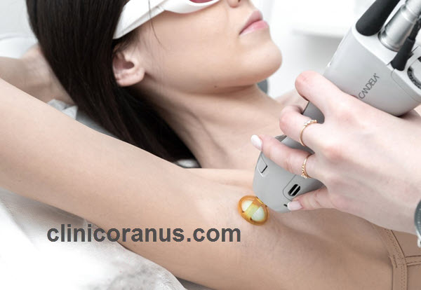 مراقبت های قبل از لیزر موهای زائد | کلینیک اورانوس