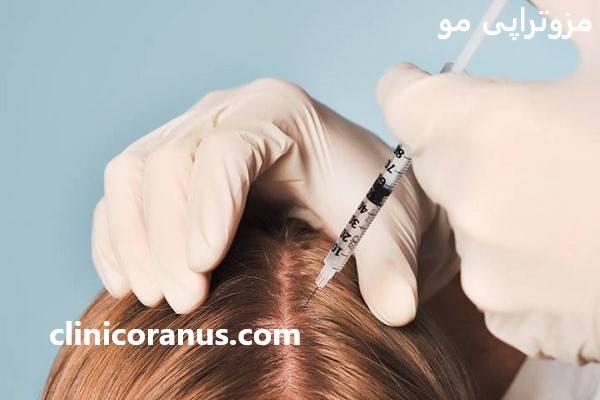 مزوتراپی مو با بهترین قیمت در تهران - کلینیک اورانوس