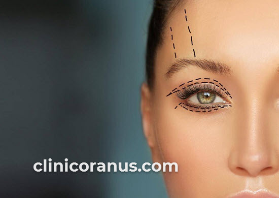 بهترین متخصص بلفاروپلاستی پلک در جنت آباد | کلینیک اورانوس