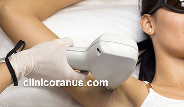 اثربخشی زیاد لیزر در رفع موهای زائد | کلینیک اورانوس