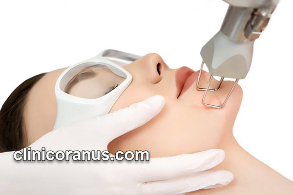 از بین بردن جای جوش صورت با بهترین دستگاه لیزر CO2 فرکشنال | کلینیک اورانوس