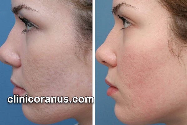 بهترین روش برای از بین بردن جای جوش با لیزر CO2 فرکشنال | کلینیک اورانوس