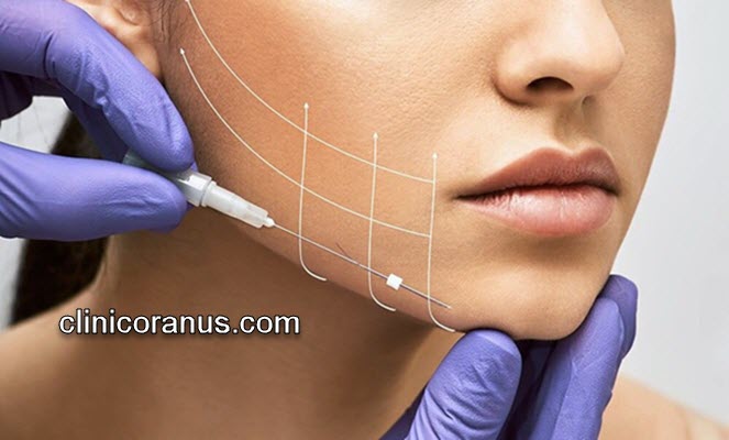 جوانسازی صورت با نخ کلاژن ساز | کلینیک اورانوس