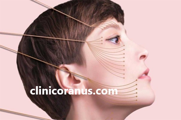 لیفت صورت با نخ فیلامنت | کلینیک اورانوس