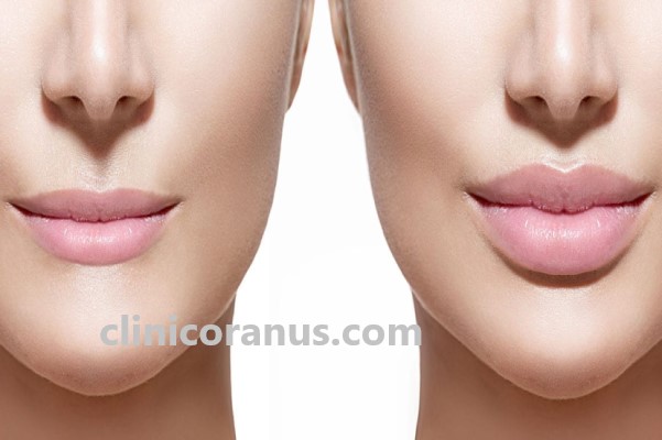 نکاتی برای افزایش طول ماندگاری ژل لب | کلینیک اورانوس