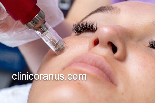 بهترین درمان برای از بین بردن جای جوش | کلینیک اورانوس