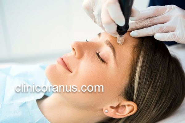 درمان جای جوش و لکه های پوستی با میکرونیدلینگ | کلینیک اورانوس