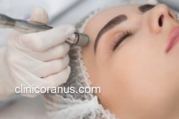 میکرودرم ابریژن برای جوانسازی و از بین بردن لک صورت | کلینیک اورانوس