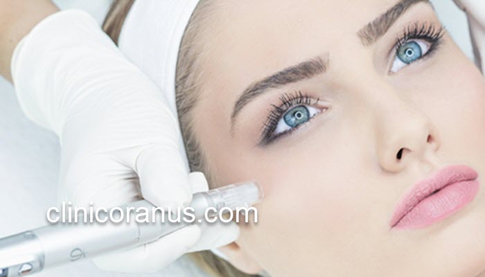 درمان لکه های صورت با میکرونیدلینگ | کلینیک اورانوس