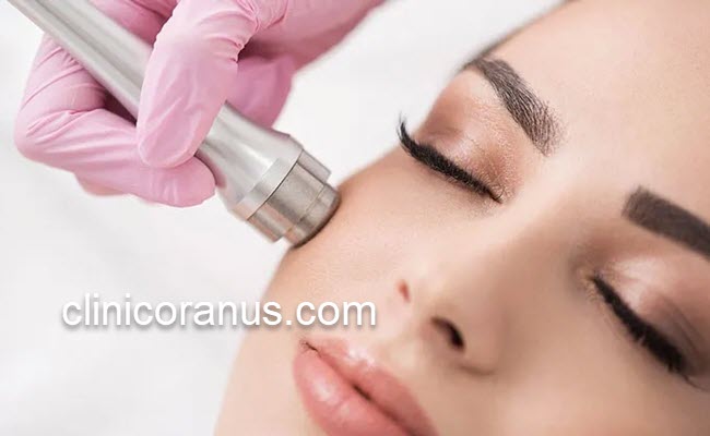میکرودرم ابریژن موثر در از بین بردن لک صورت | کلینیک اورانوس