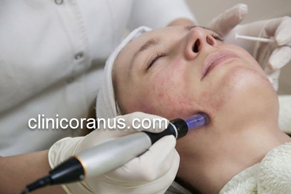 درمان جای جوش با میکرونیدلینگ صورت | کلینیک اورانوس