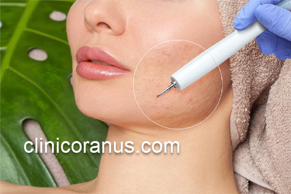 از بین بردن جای جوش و زخم با سابسیژن | کلینیک اورانوس