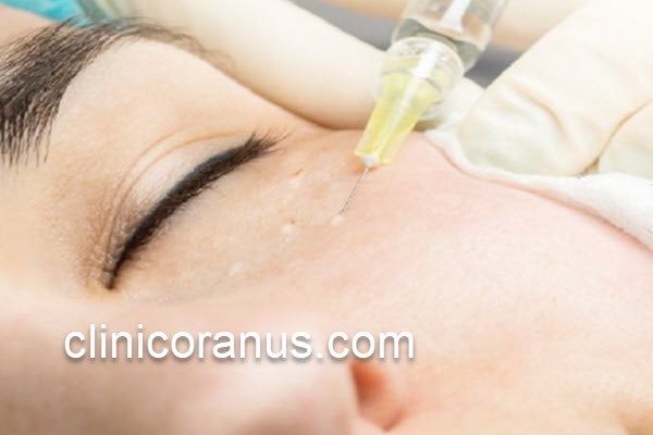 مزوتراپی زیر چشم با تأثیرات بالا | کلینیک اورانوس
