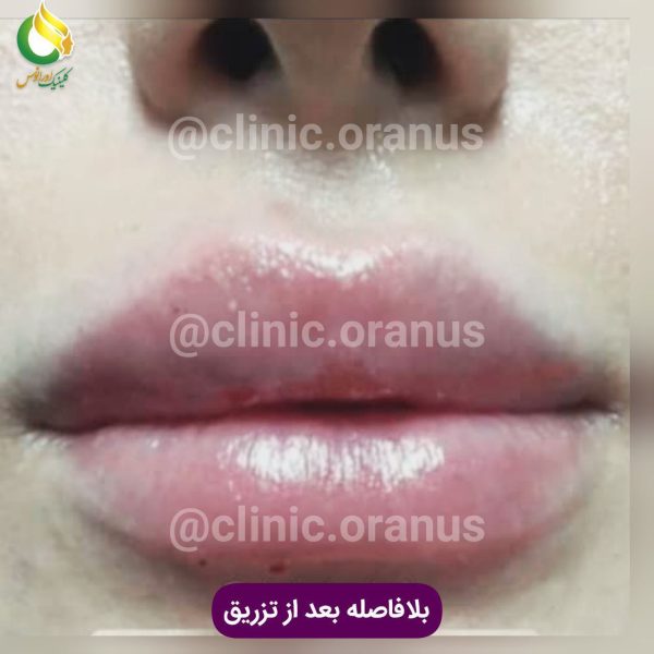 تزریق فیلر لب در کلینیک زیبایی اورانوس | جنت آباد   غرب تهران