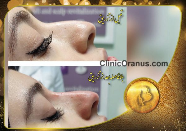 تزریق فیلر بینی در بهترین کلینیک زیبایی غرب تهران | اورانوس