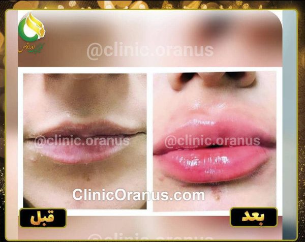تزریق فیلر لب در کلینیک زیبایی اورانوس | جنت آباد - غرب تهران