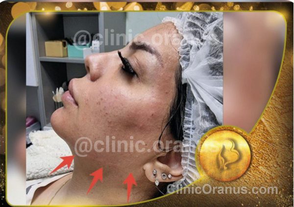 تزریق فیلر زاویه سازی فک صورت در کلینیک زیبایی اورانوس | جنت آباد - غرب تهران
