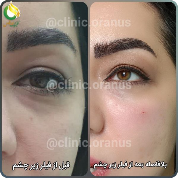 تزریق فیلر زیر چشم در کلینیک زیبایی اورانوس | جنت آباد - غرب تهران