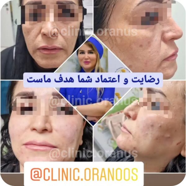تزریق فیلر در بهترین کلینیک زیبایی در غرب تهران | اورانوس