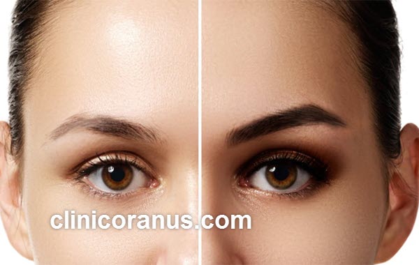 فاکتورهای مؤثر بر قیمت کاشت ابرو | کلینیک اورانوس