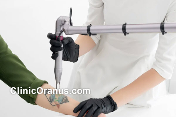 مراقبتهای بعد از لیزر کیوسوئیچ | کلینیک اورانوس