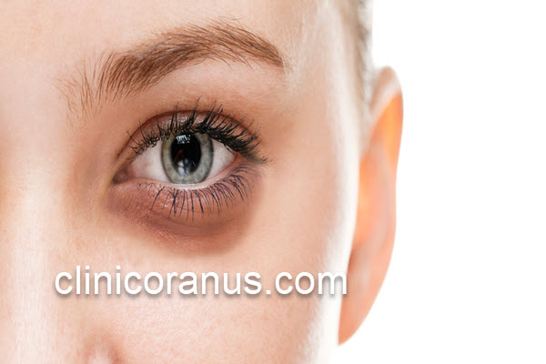 رفع سیاهی و پف زیر چشم با تزریق فیلر | کلینیک اورانوس