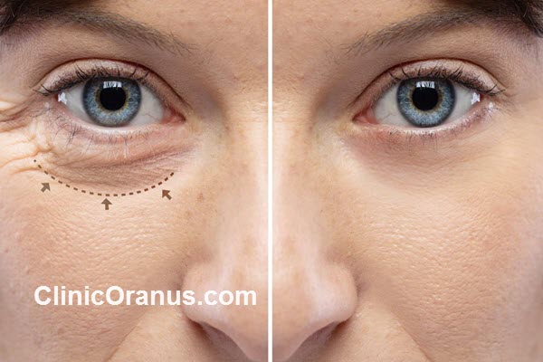 بلفاروپلاستی | کلینیک اورانوس